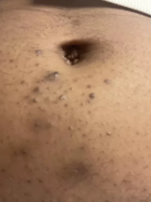 Ingrown hair on my belly button..sometimes puss filled by jasminejc4525