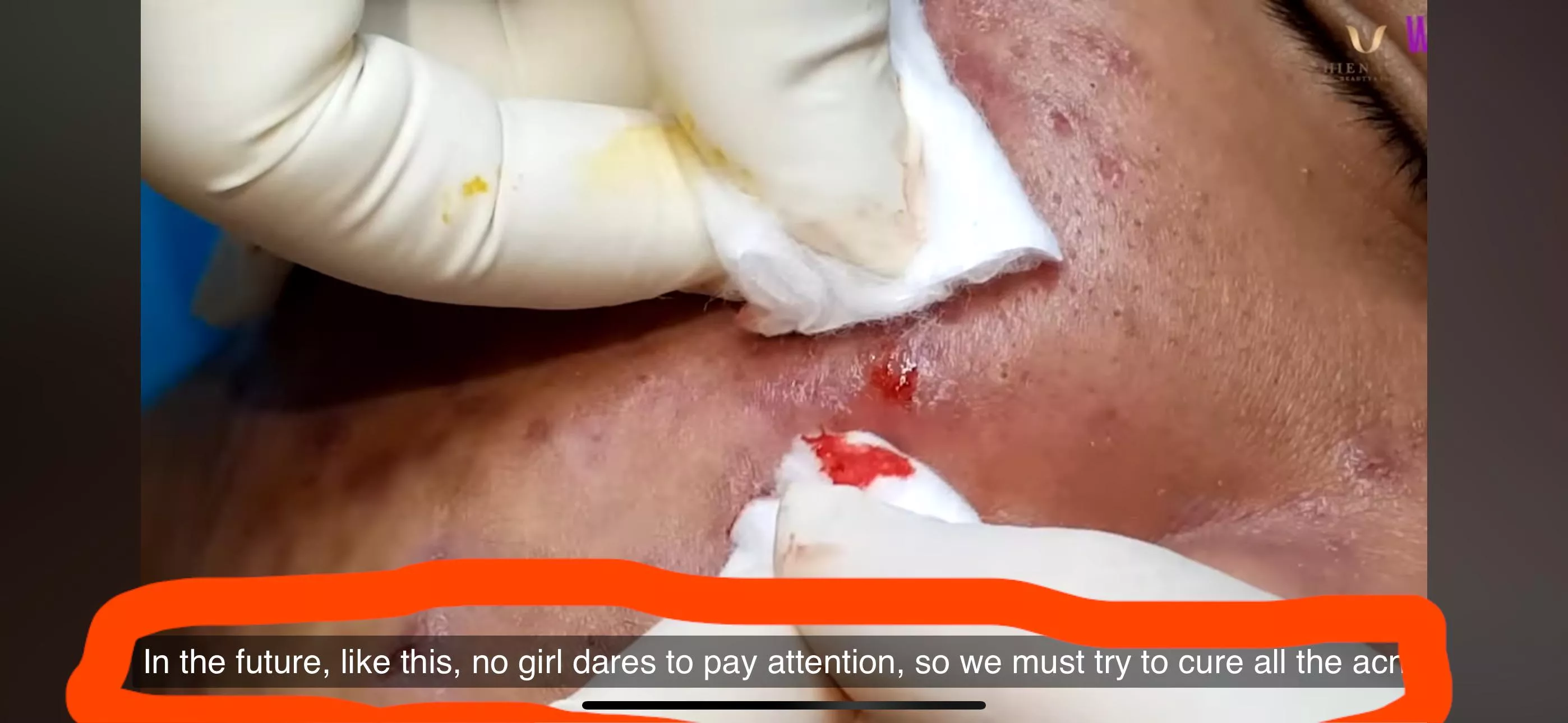 HHV Clinic and the CC commentary is OFF THE CHAIN. 😬. Love the cystic pops, but this tech is ROASTING her client. Like you just said whaaaat to him?? posted by jopesak