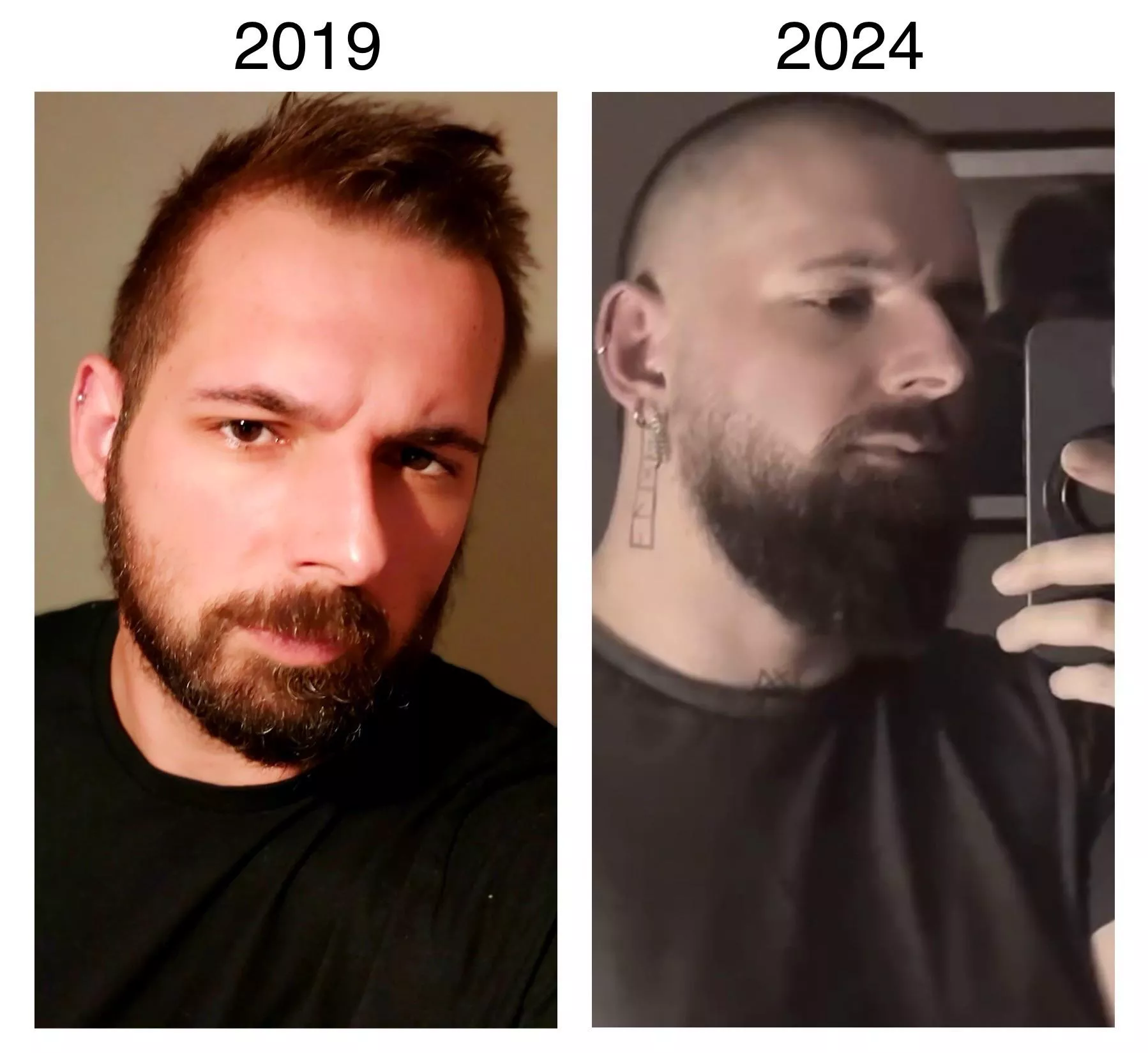 My hair migrated 😂 posted by french_beard