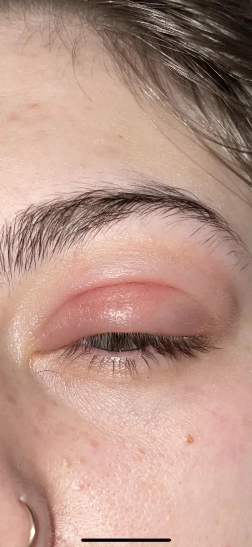 Forbidden pop! 2nd Presepstic cellulitis by chuggychoochoo