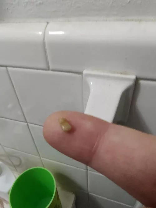 Woke up coughing up this bad boy by babyblazey