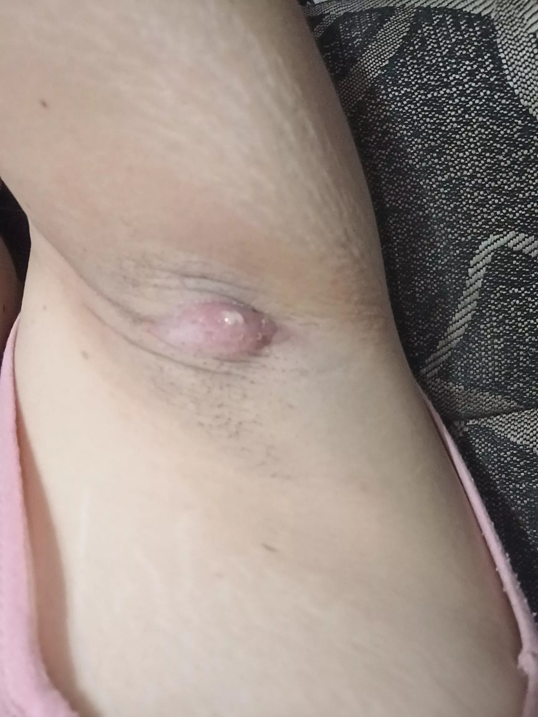 is my armpit boil finally rupturing? posted by prettylibrarian98