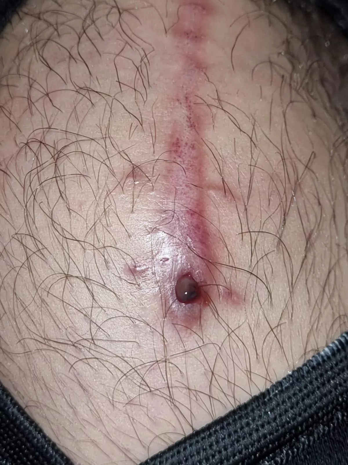 This popped out of my knee scar, a month after surgery posted by worst_man_1