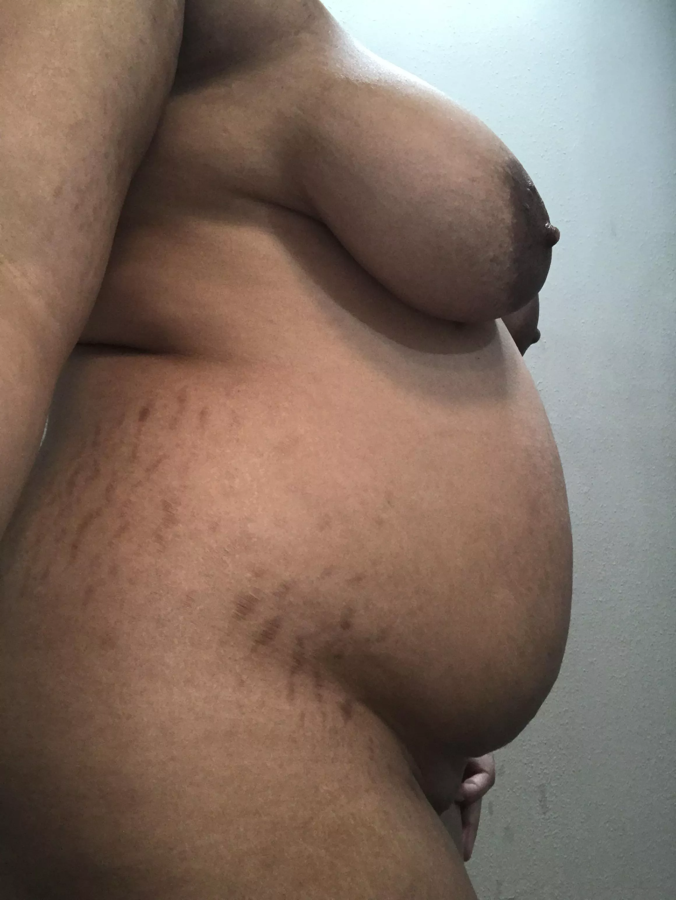 Stretch marks from growing too fast 😅 posted by Life_Competition4438