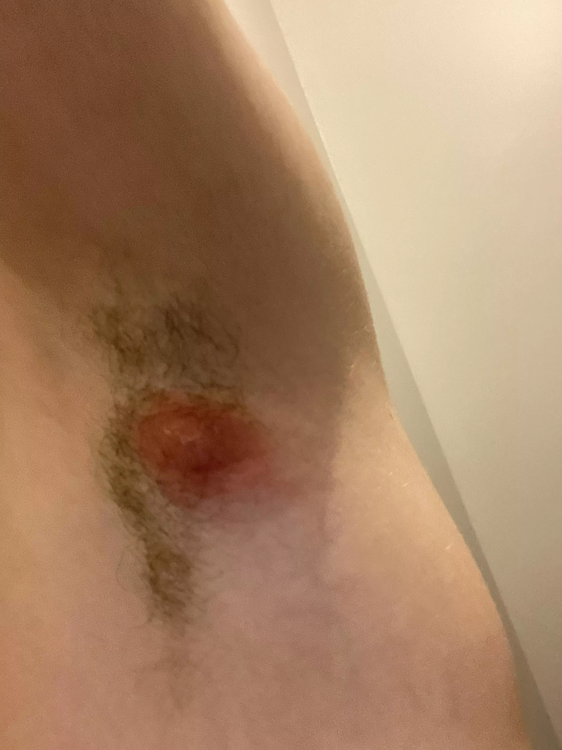 Massive abscess on armpit,stay tuned for possible lancing video tomorrow? posted by arkansasmf
