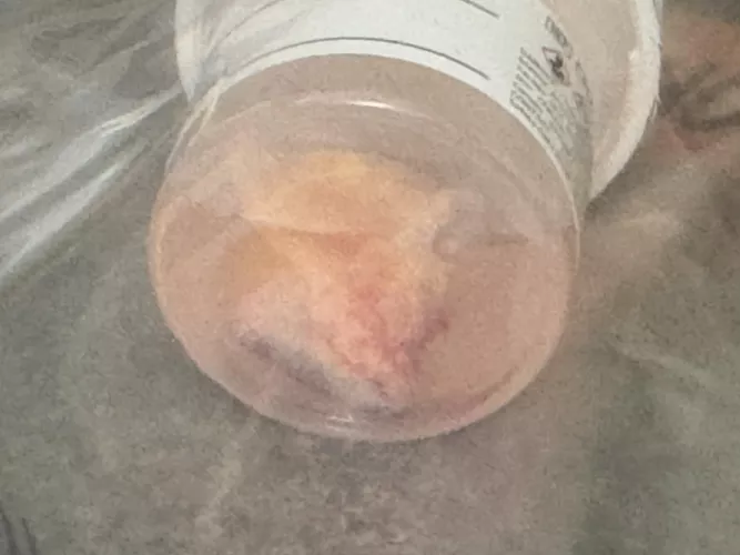 Cystectomy earlier this week by dakennyj