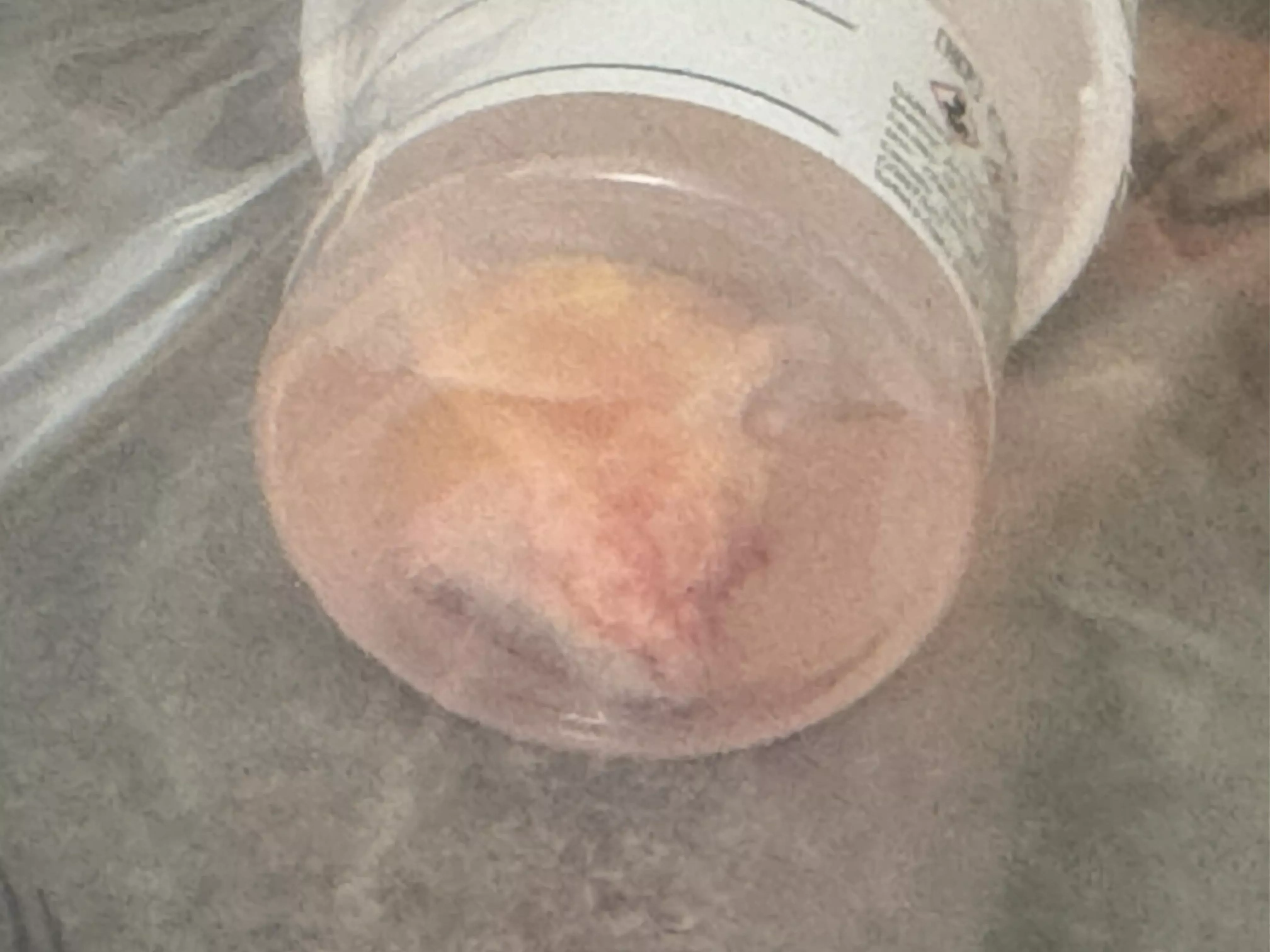 Cystectomy earlier this week posted by dakennyj