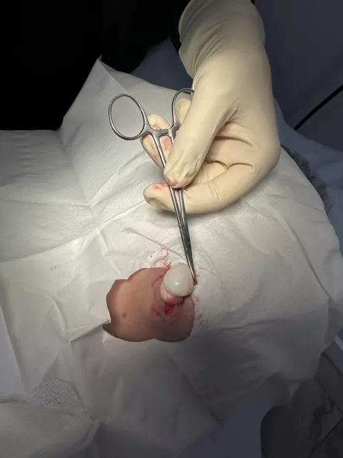 Surgical removal of Cyst by Syncity-