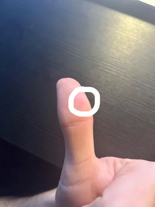 This weird white dot on my thumb hurts when it’s squeezed or pressed hard. What is it? by kylemdrury