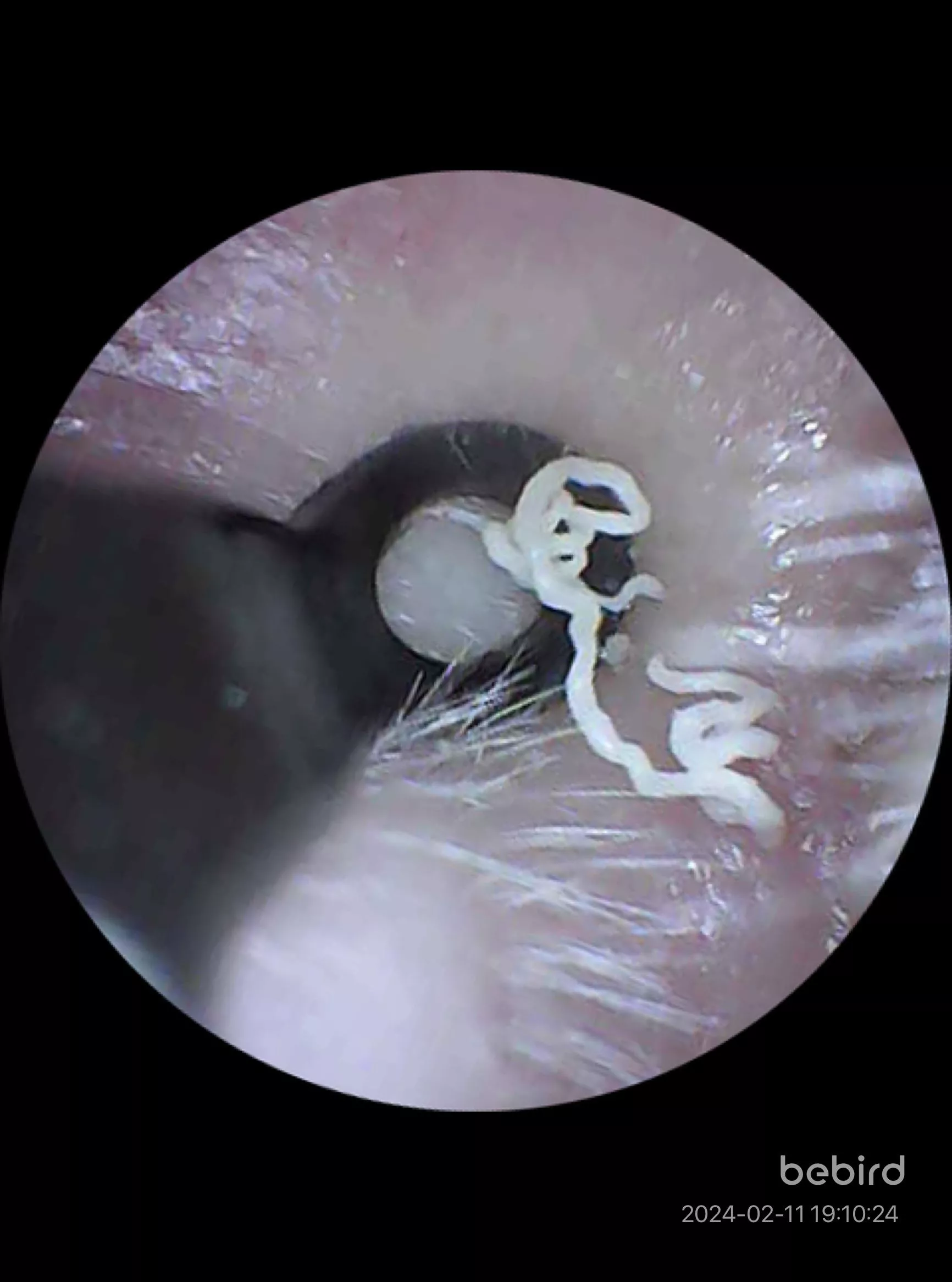 Ear blackhead that pops every so often posted by motherofhobbitses