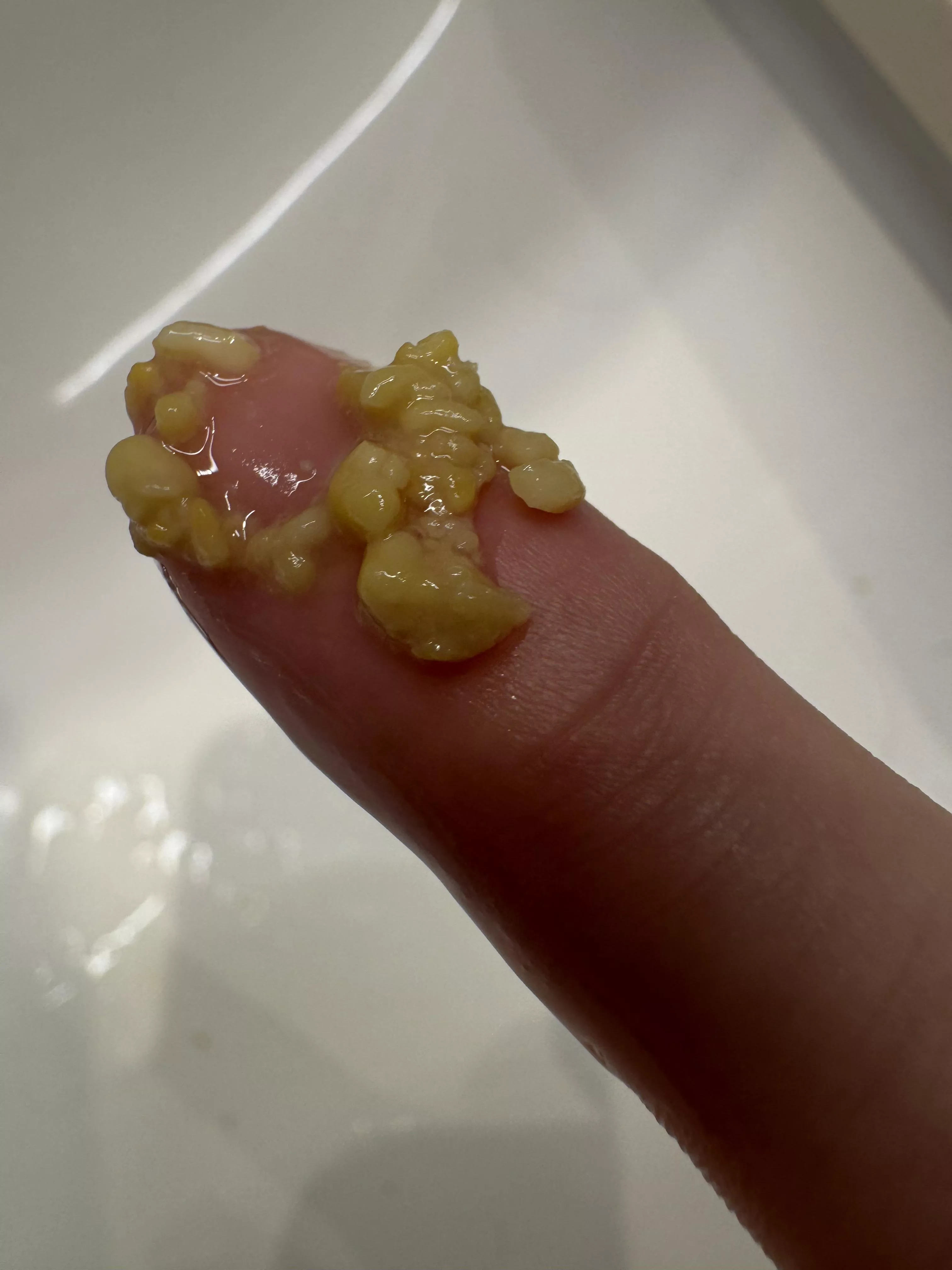 I woke up and could feel these tonsil stone in my mouth posted by Kronocide