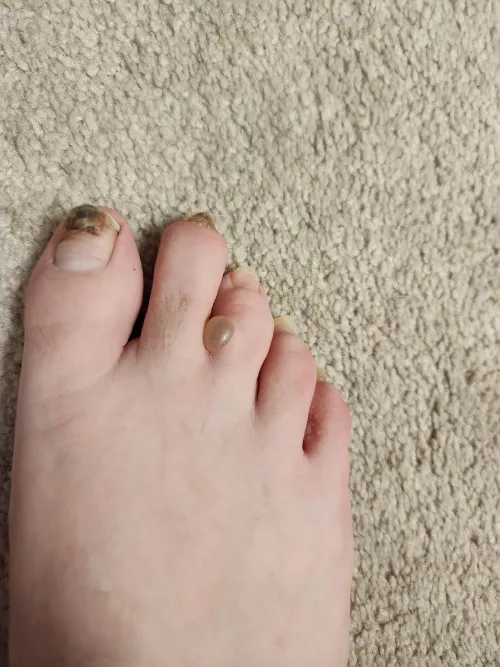 Athletes foot blister. by BranchNo2807