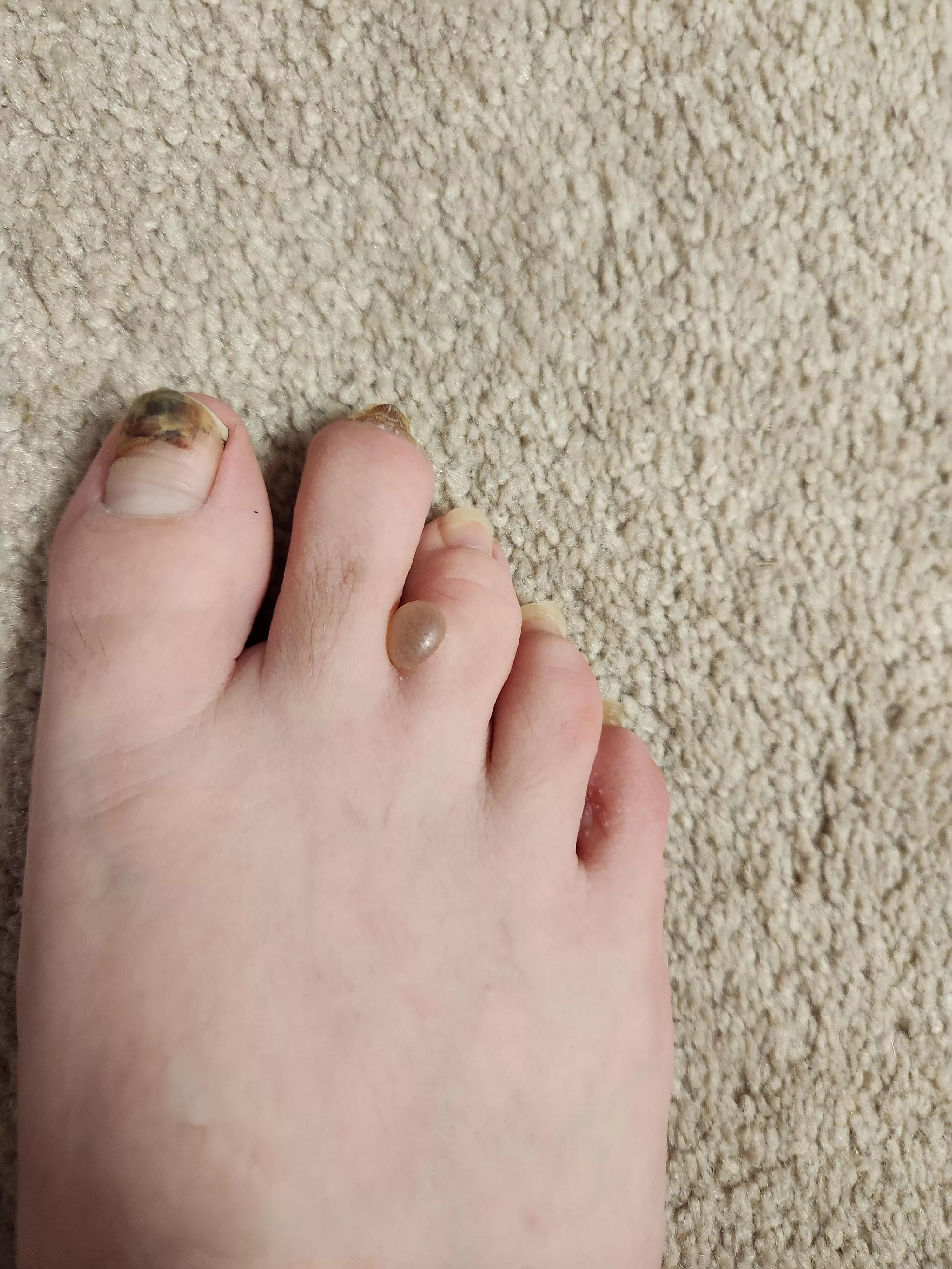 Athletes foot blister. posted by BranchNo2807