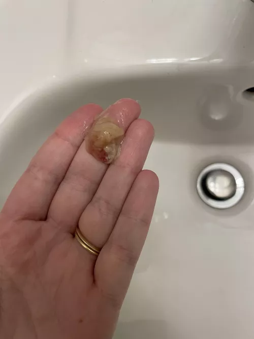 Felt this come out - dealing with strep throat by Fancy-Interest