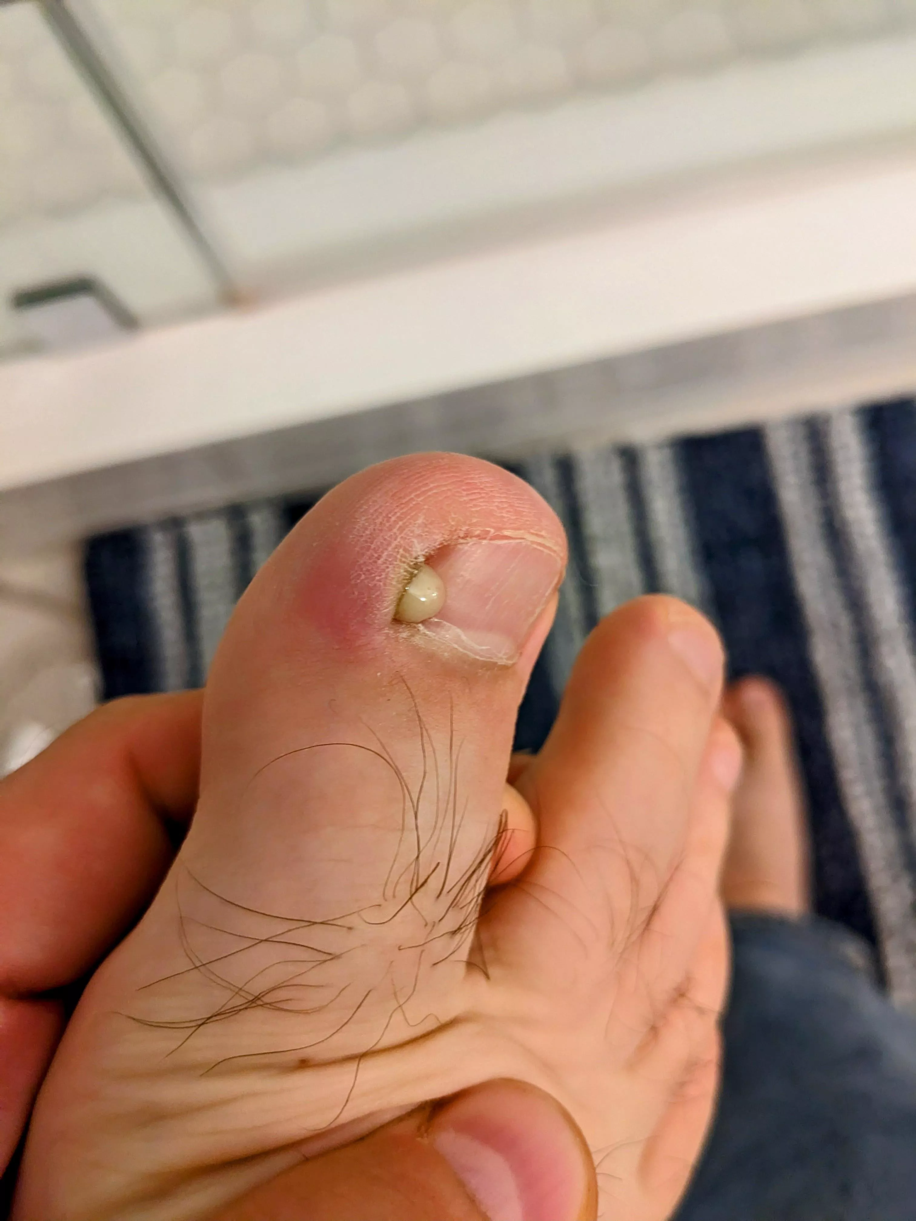 Ingrown toenail pop! posted by captchabandit