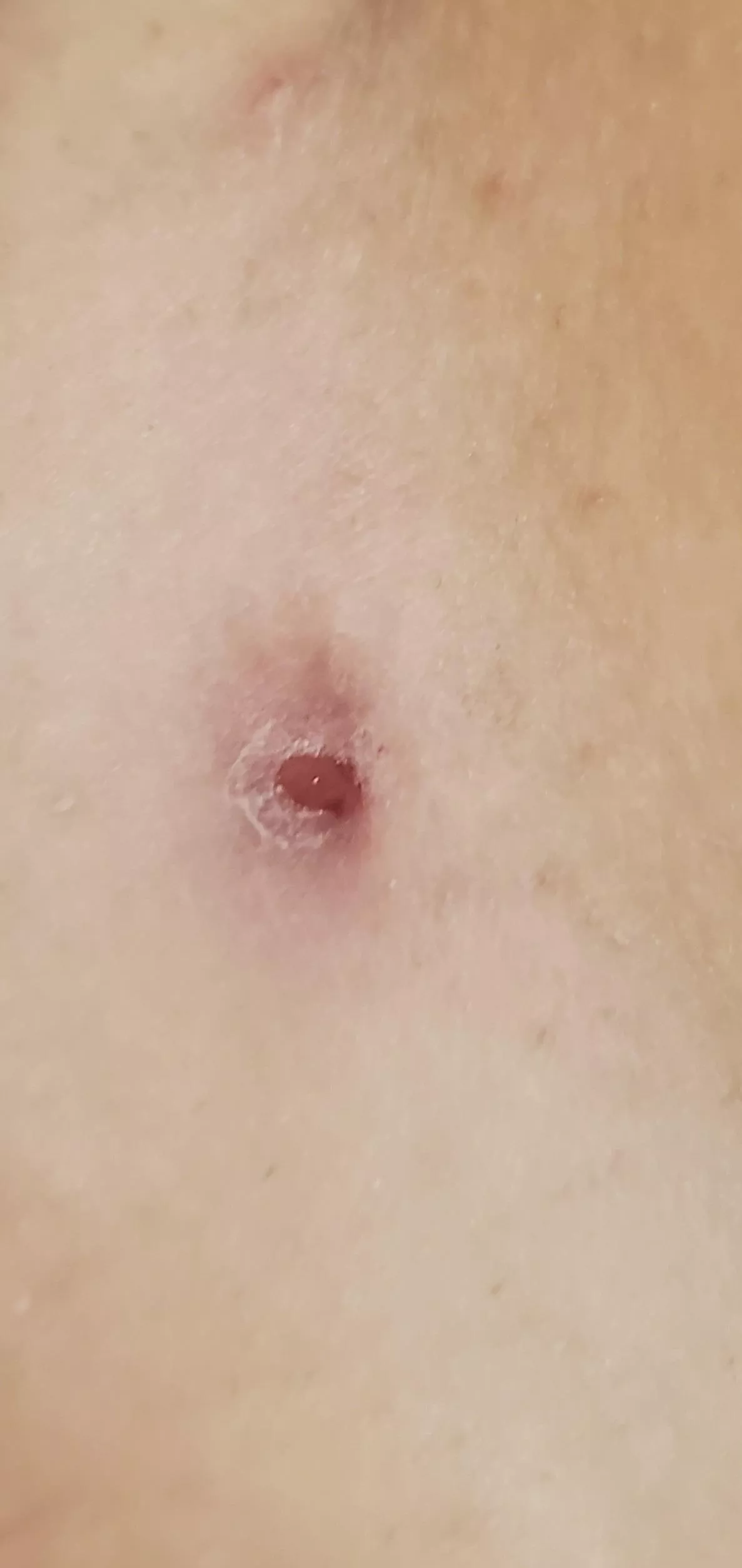 Bikini line cyst/abscess help :( posted by poopwaffle