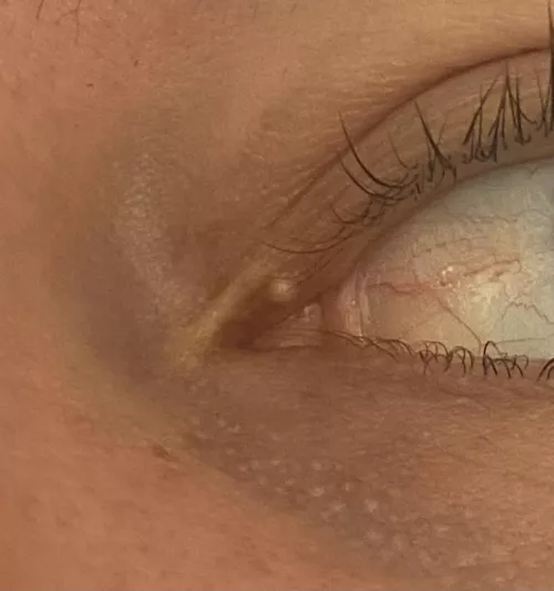 Where do I go to get this taken care of? Milia? by themaddhatt