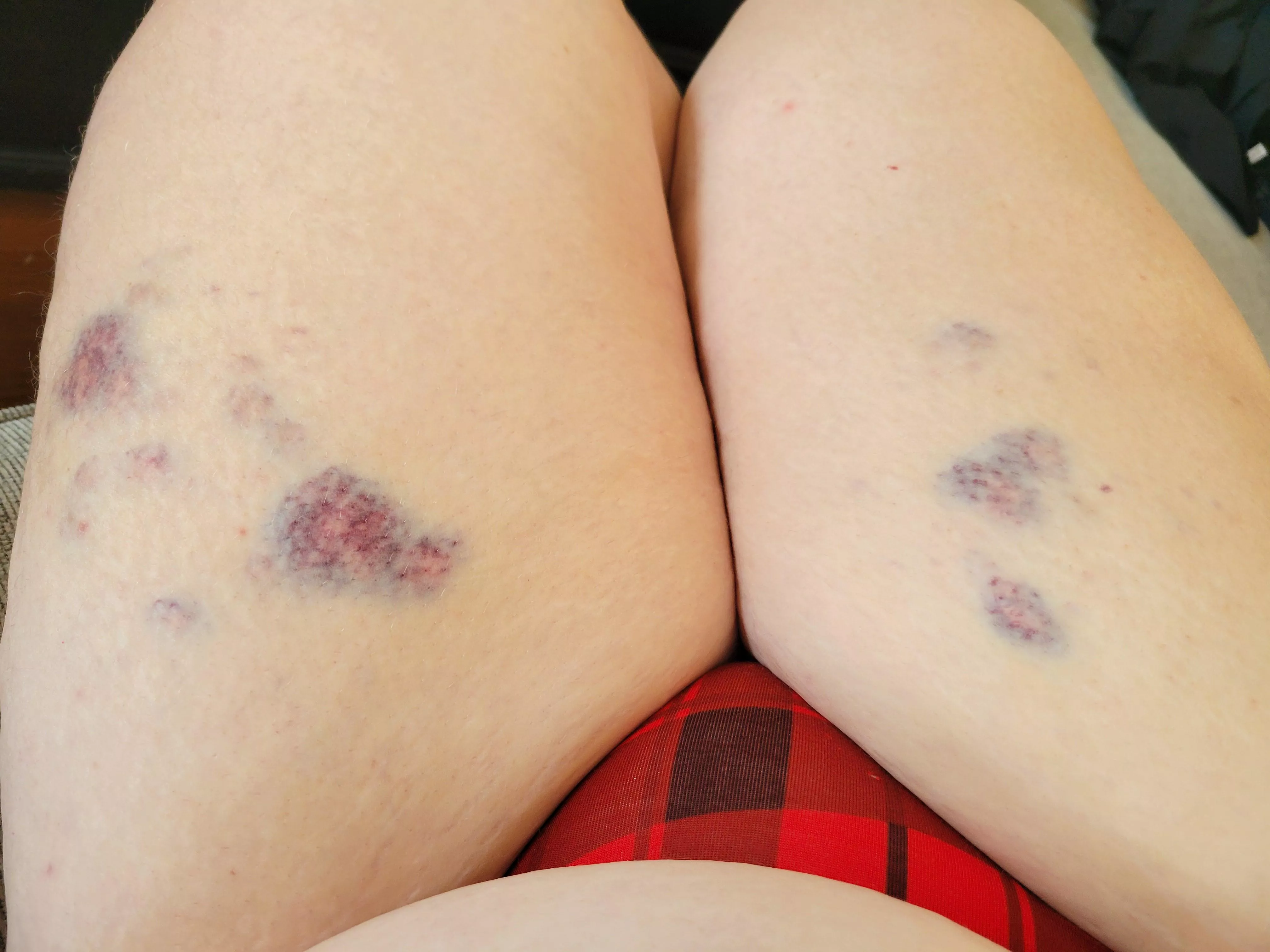 Amateur masochist here — received a nice flogging by my  domme :) posted by CaptainCellulose