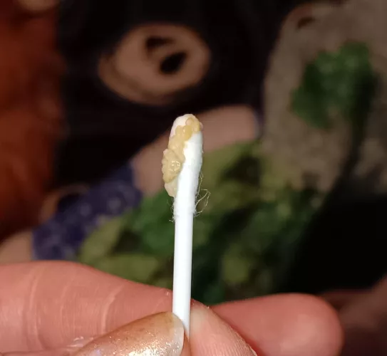 Tonsil puss from strep throat  by Next-Adhesiveness957