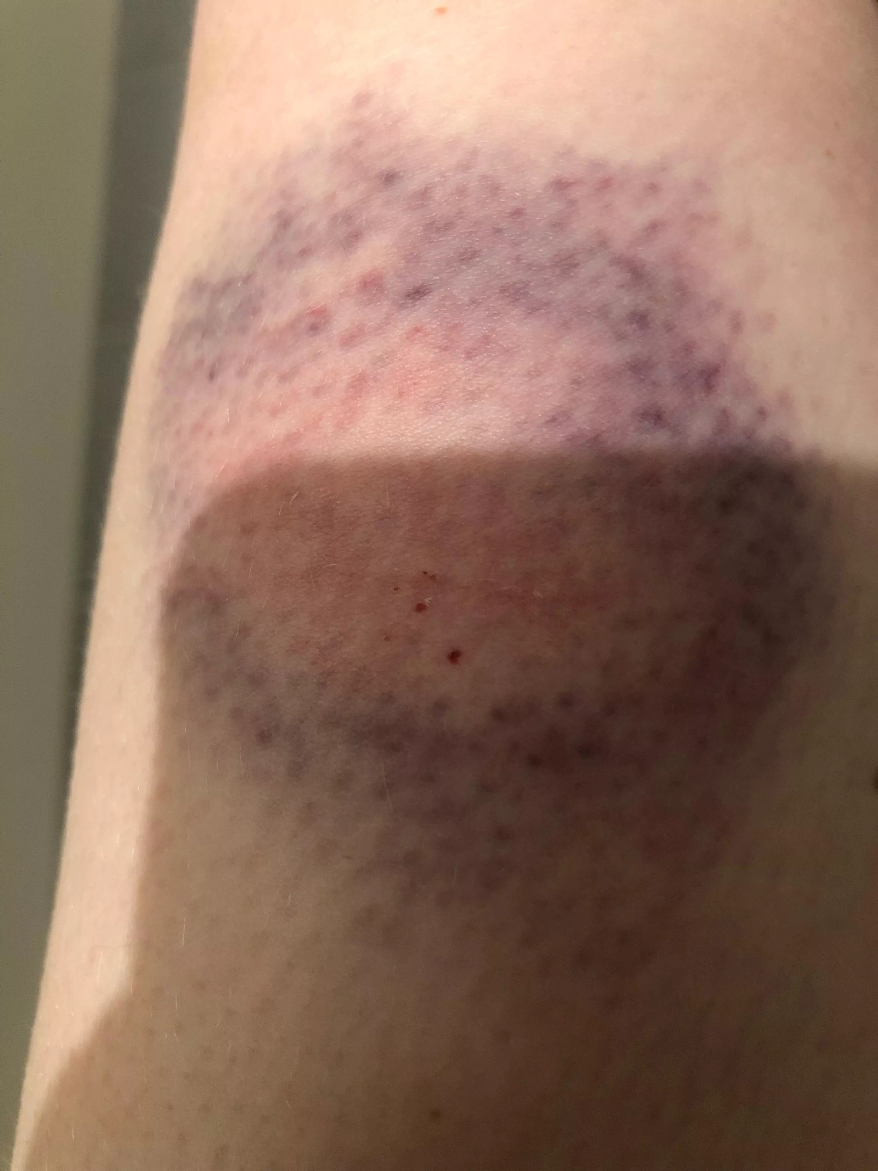 A fly wacker on my leg posted by jellsji