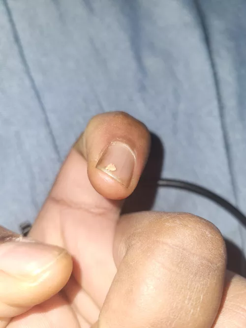 Ear pimple that won't leave part 3 (the end) by Laylaycrayz