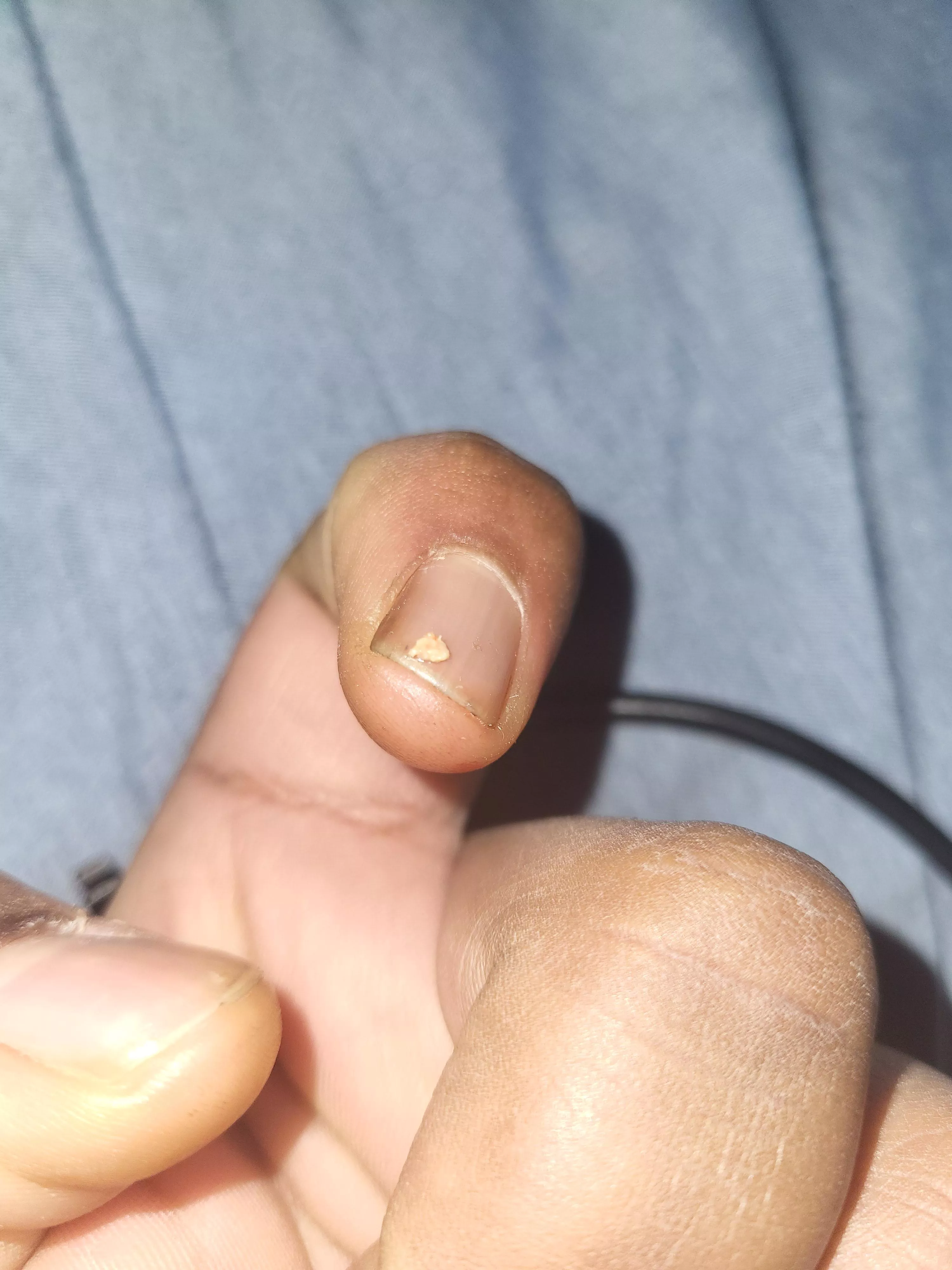 Ear pimple that won't leave part 3 (the end) posted by Laylaycrayz