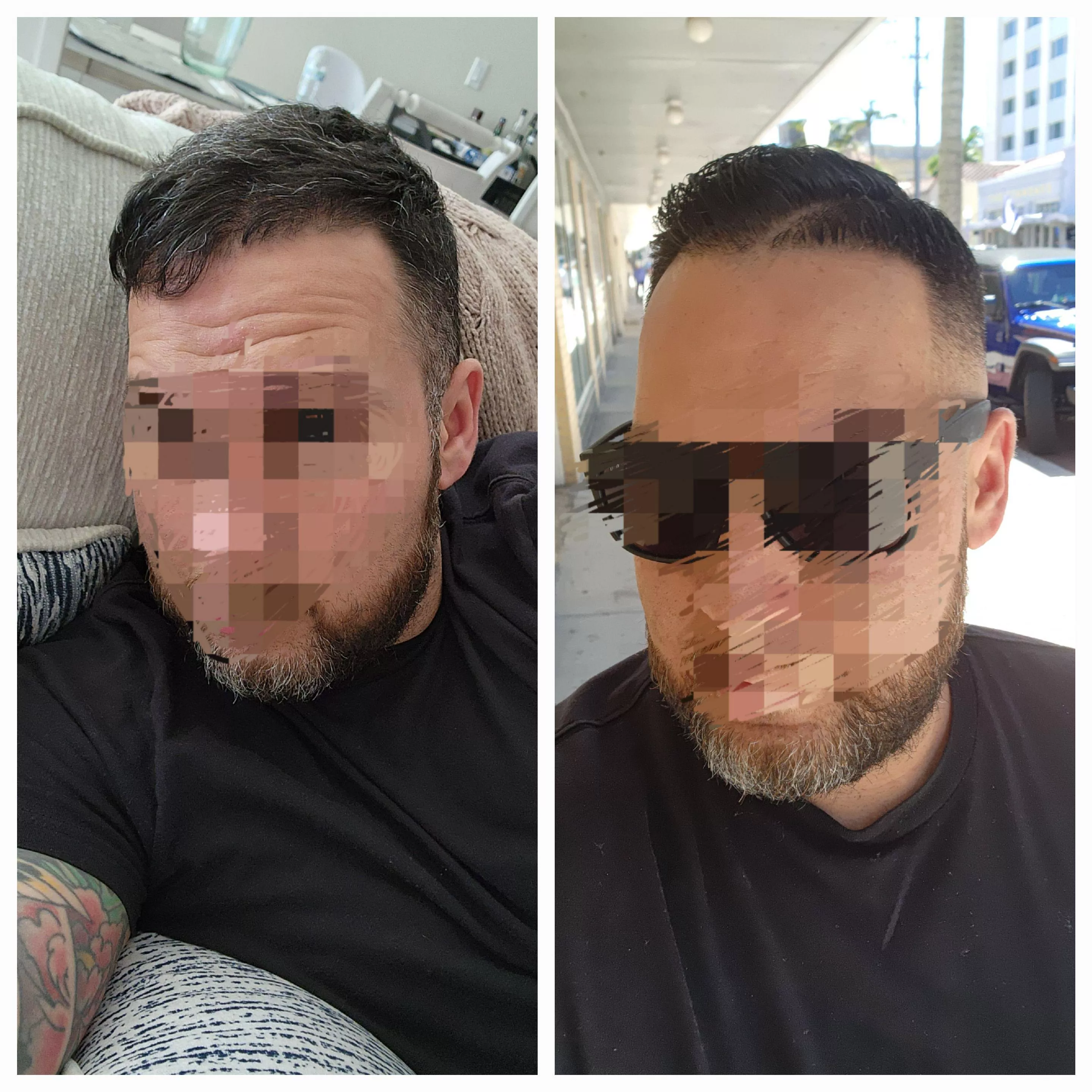 (38m) Before and after  posted by JJFreakShow