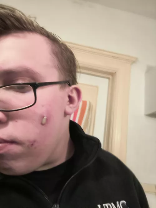 Face stuff. Been using cervae, doxycycline and face wash twice a day.  by Moist-Mix-1161