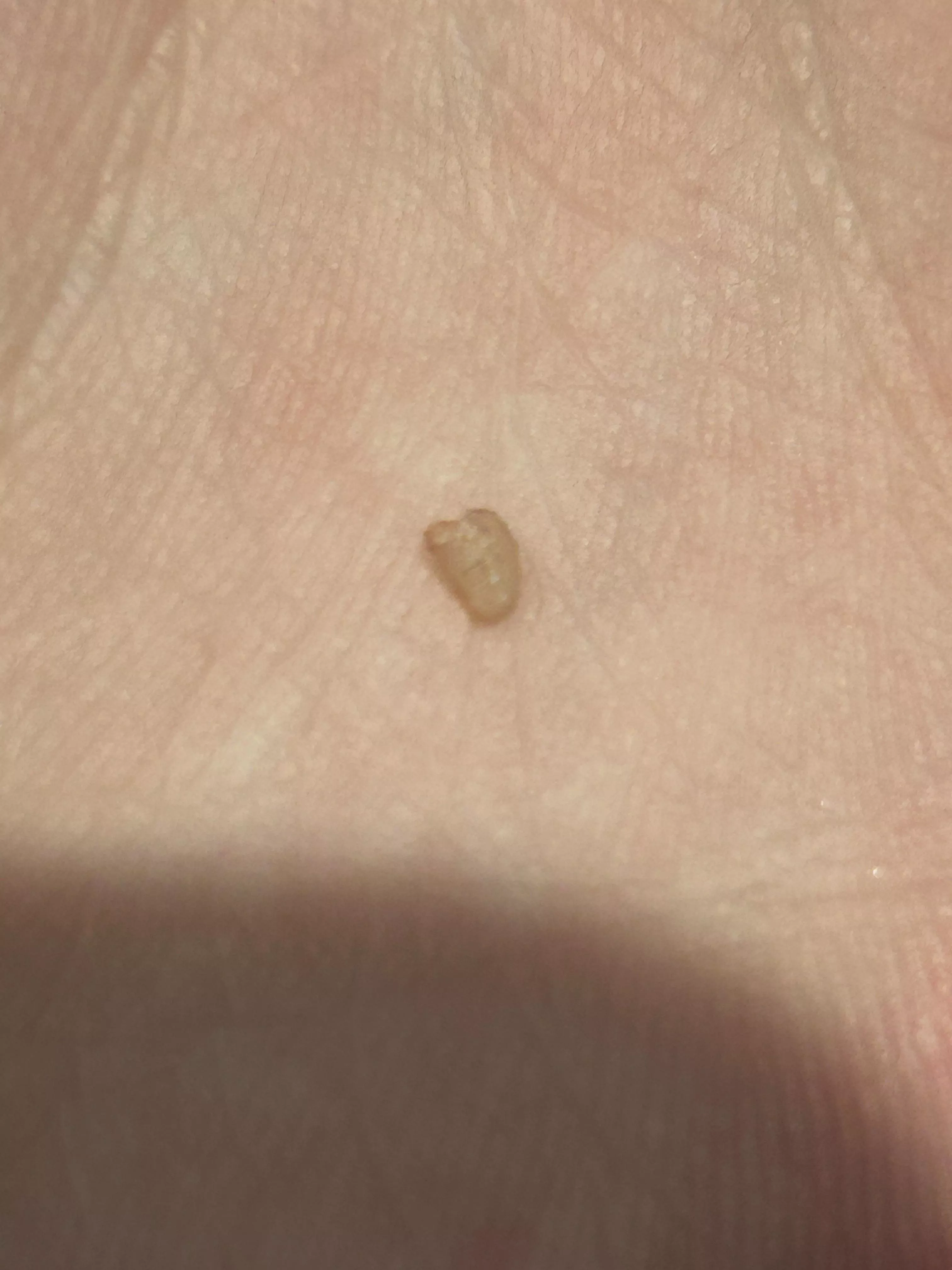 I popped and pulled this out of what started as an ingrown hair on my private part… any idea what it is? A cyst?  posted by Tommyl33