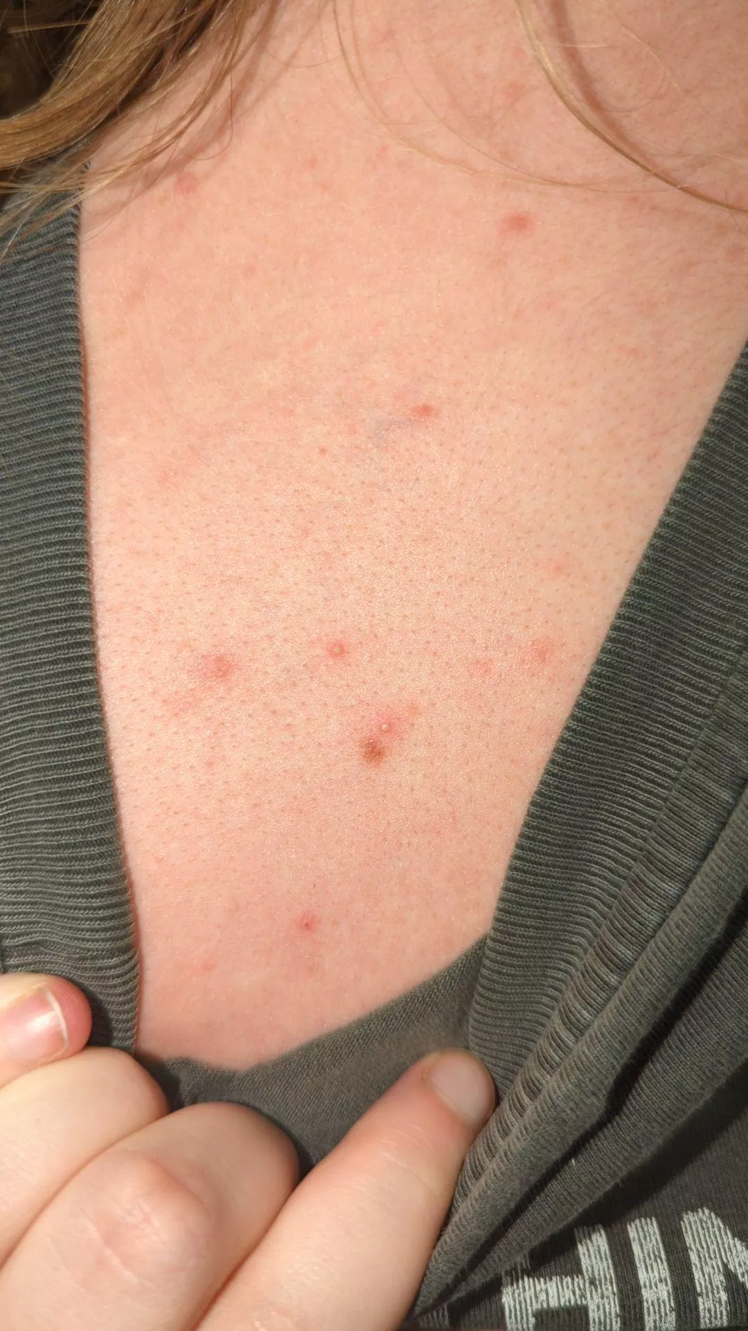 Little whiteheads on boyfriend's back  posted by Foreign_Project_3790