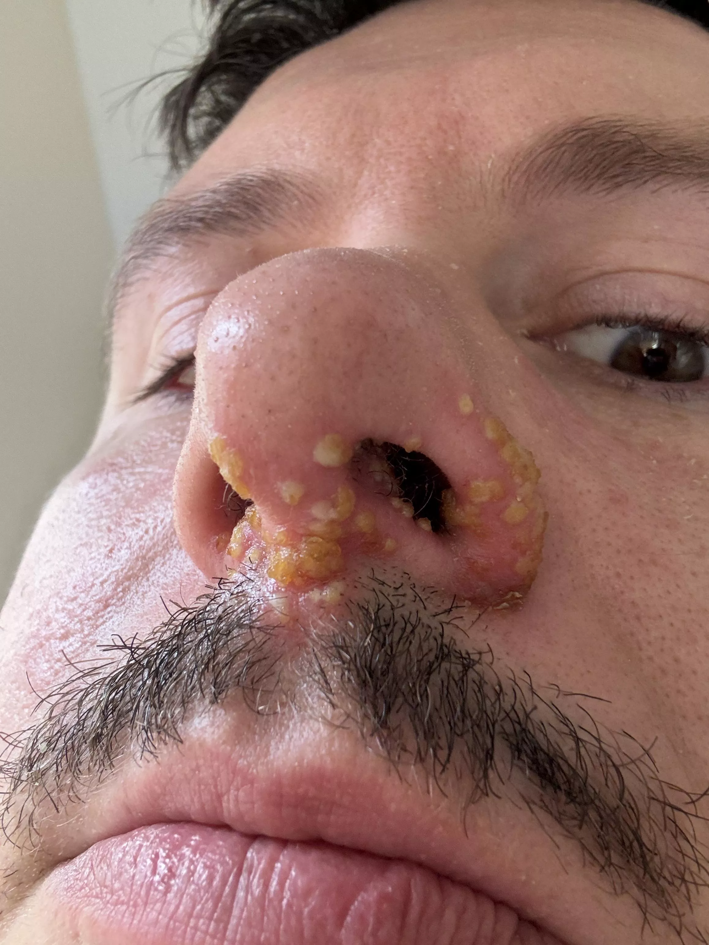 Cold Sores or Shingles? posted by Olibra