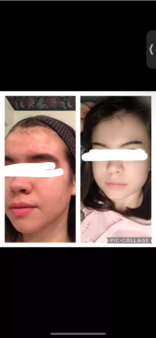 Skin picking disorder before/after by DaddyBrielle