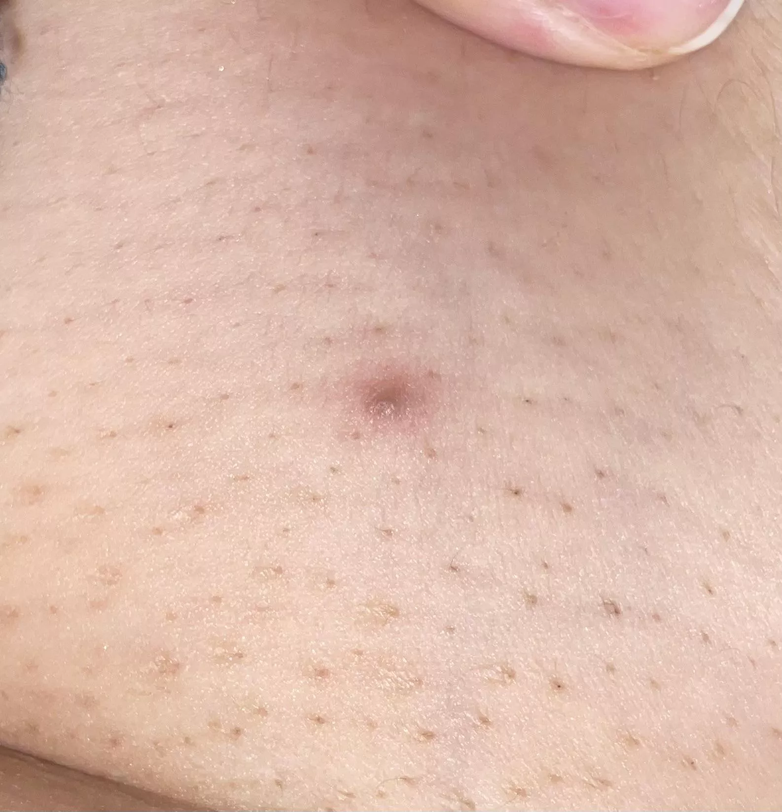 Ingrown from my last laser hair removal session :( posted by throwawaayyyyy77