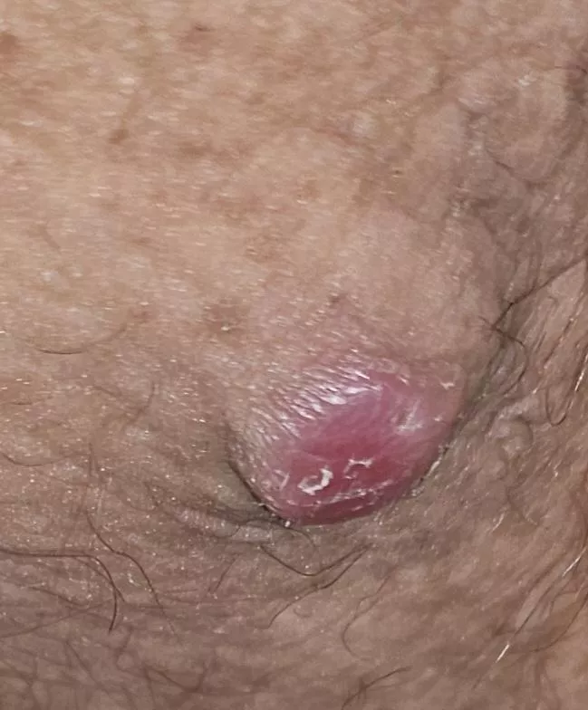 Big boi that i am scared to pop posted by xxclrbrxx