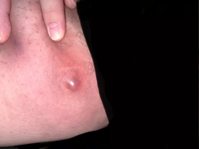 Just fucking pop already by TasterOfPork