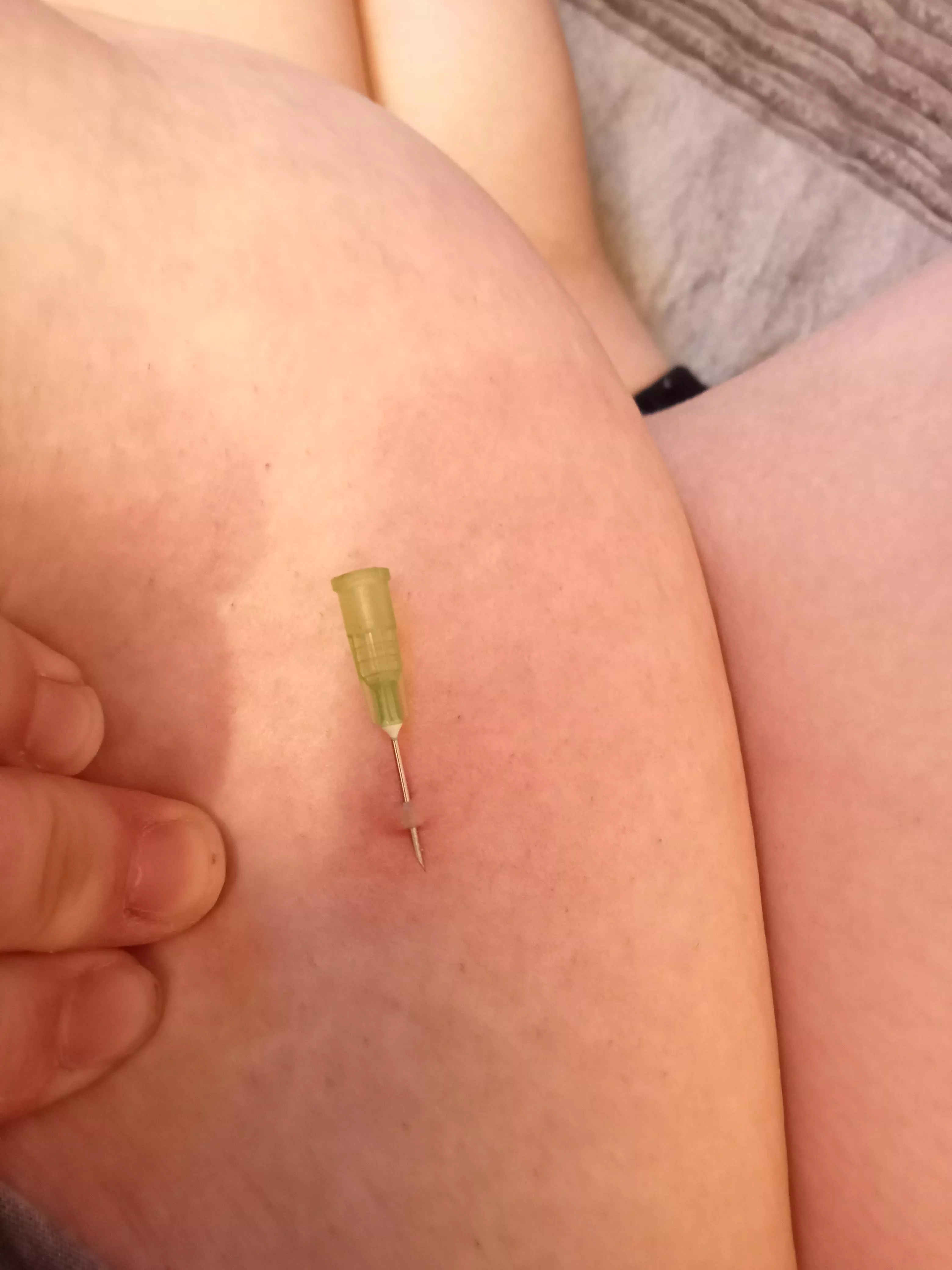 Oooh a tunnel. Reoccurring blackhead posted by popitty_pop