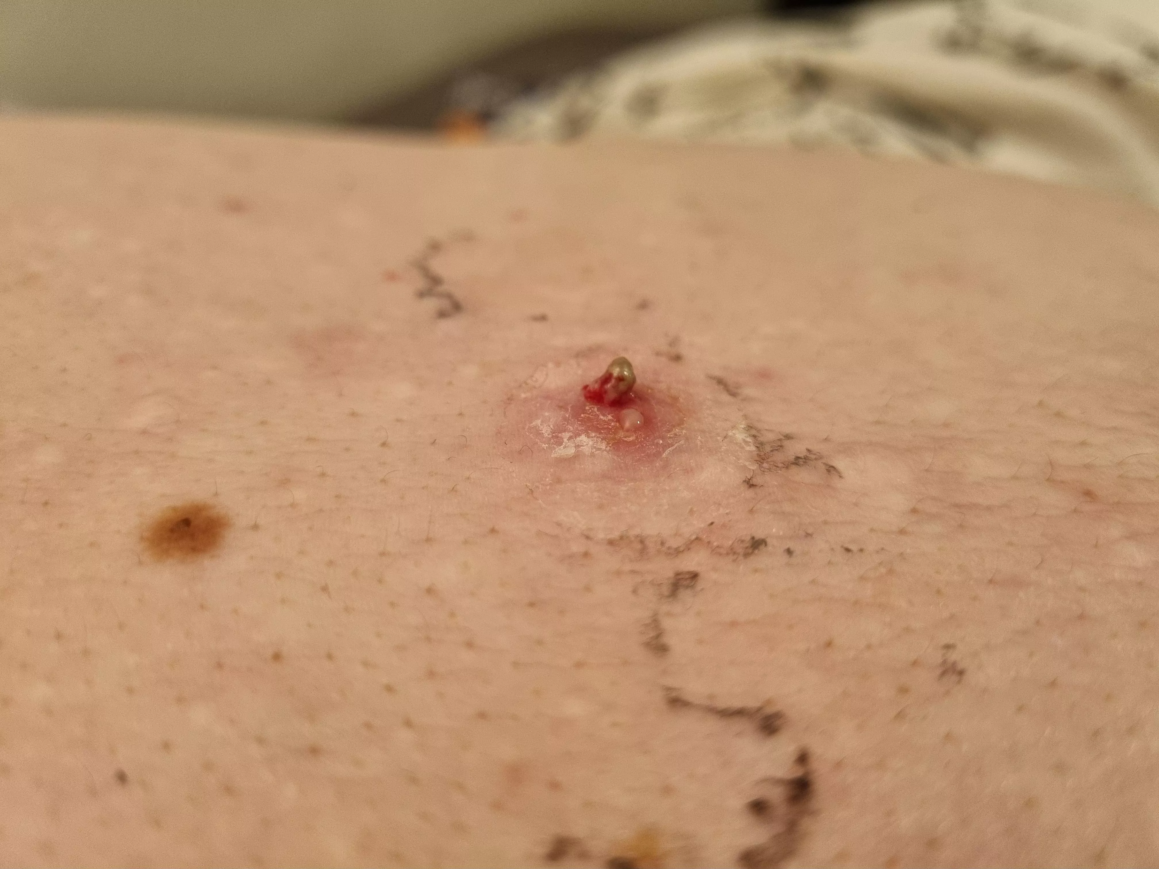 Old picture of a large, red thing brewing up. It popped on it's own under a bandaid and needed only a gentle push to get this hard nugget out of it. Instant relief. posted by Popping-account
