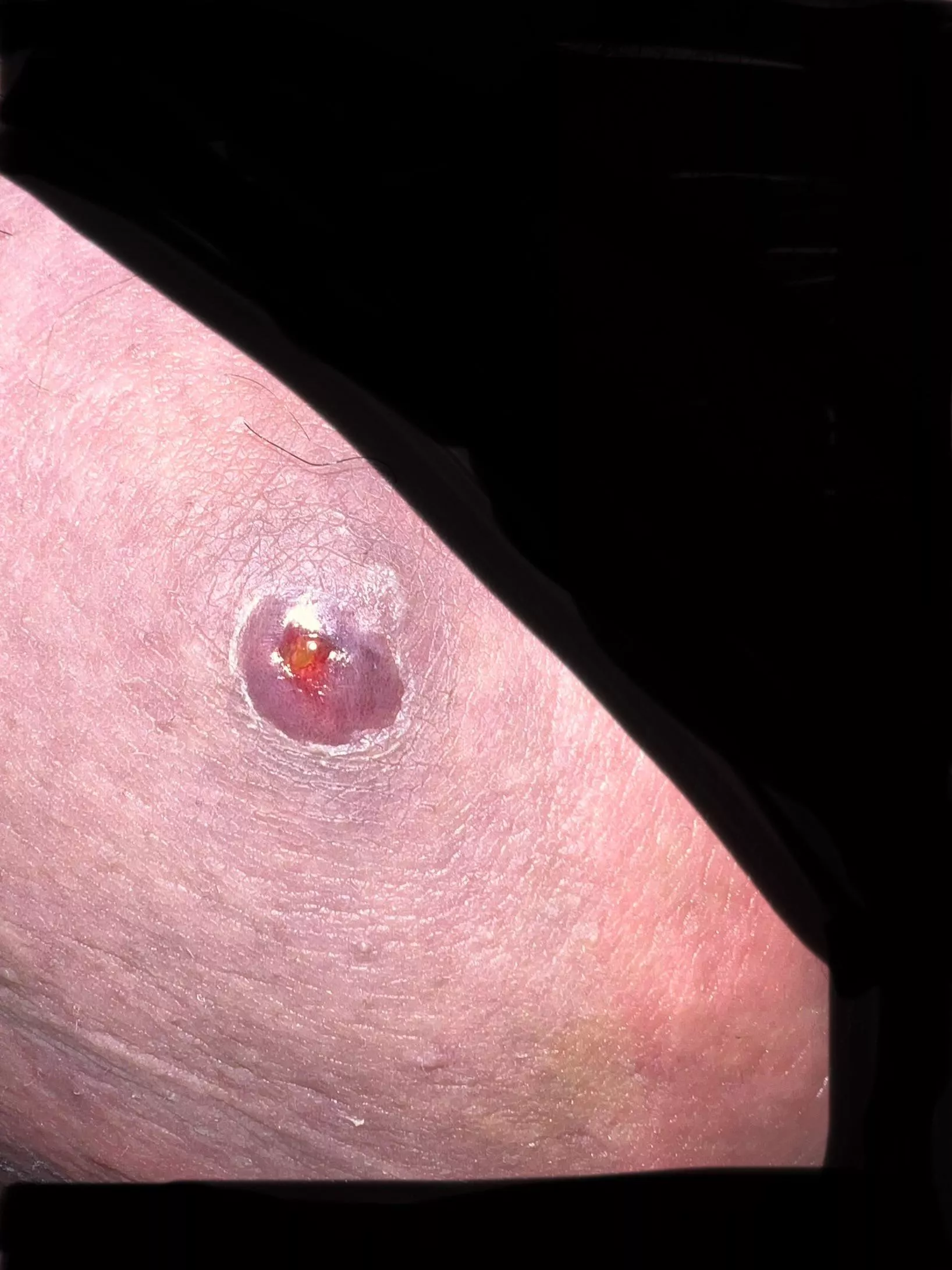 72 hours after popping posted by TasterOfPork