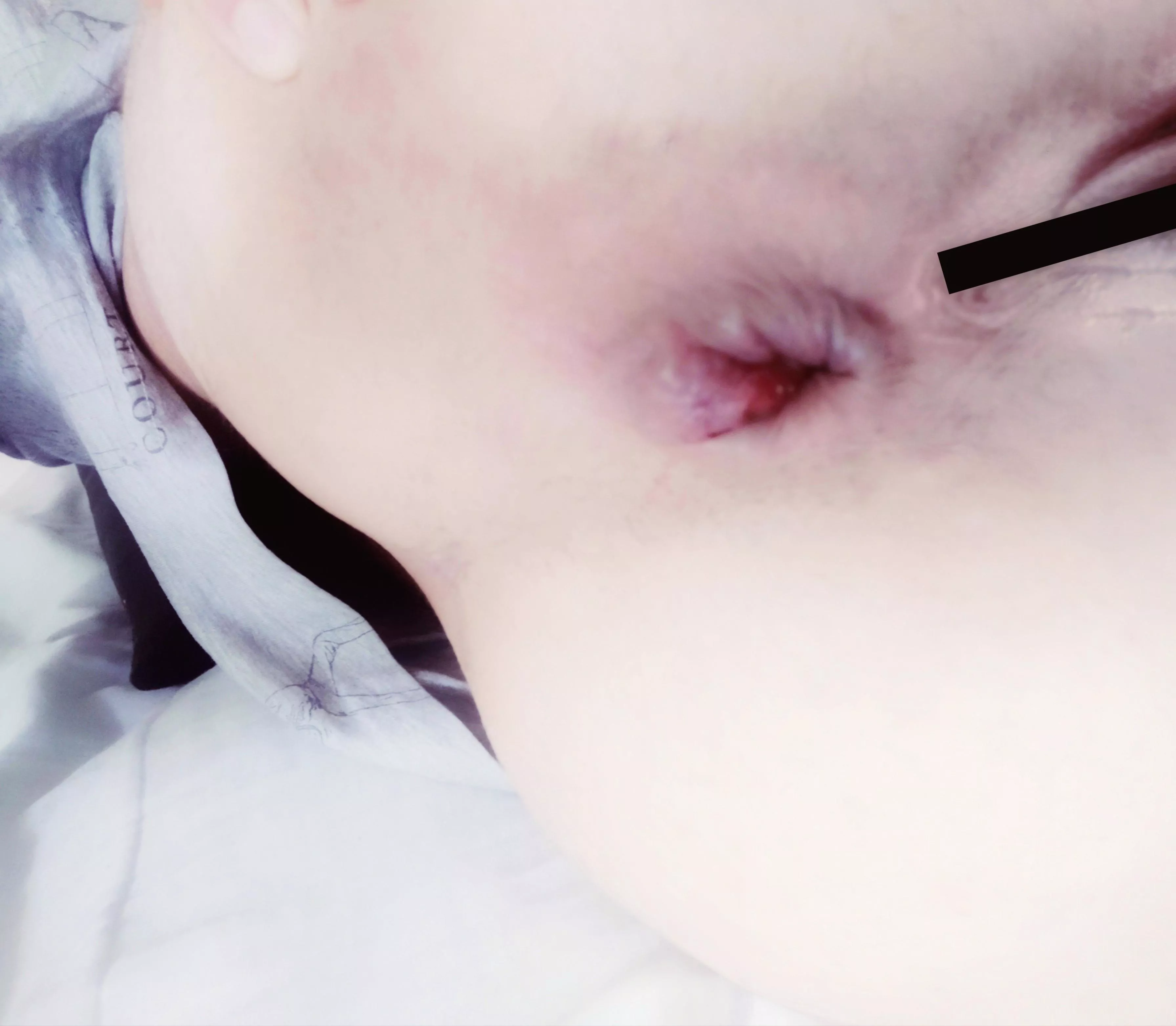 My hole after some hard anal fisting 😳 (oc) f 28  posted by soldaderyan