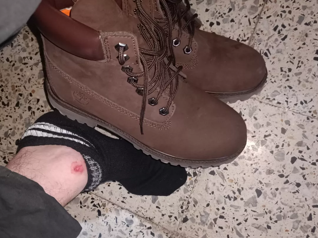 Side ankle blisters  posted by censored_996