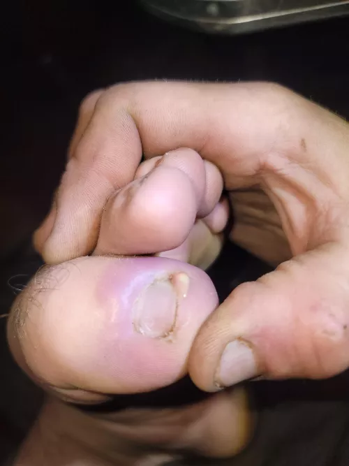 Got a staph infection under my toenail. Oh, the relief by CandyApple69420