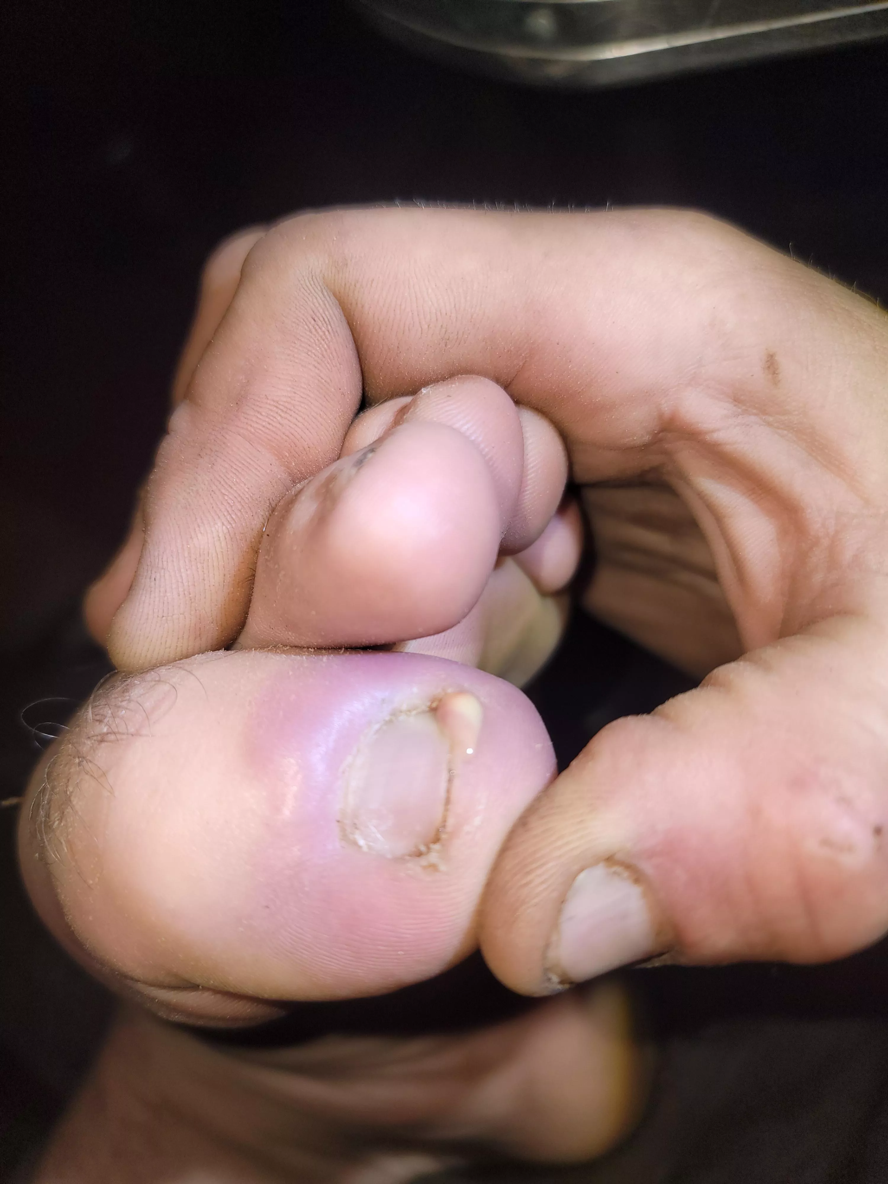 Got a staph infection under my toenail. Oh, the relief posted by CandyApple69420