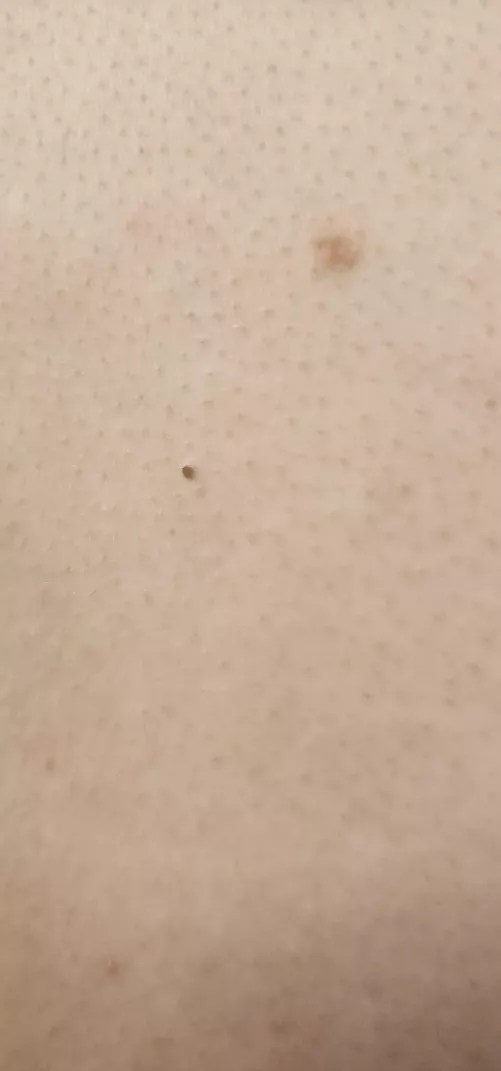 I so wish my roomie would let me pop this blackhead. You can tell it's a fat boy. by Prior-Building5640