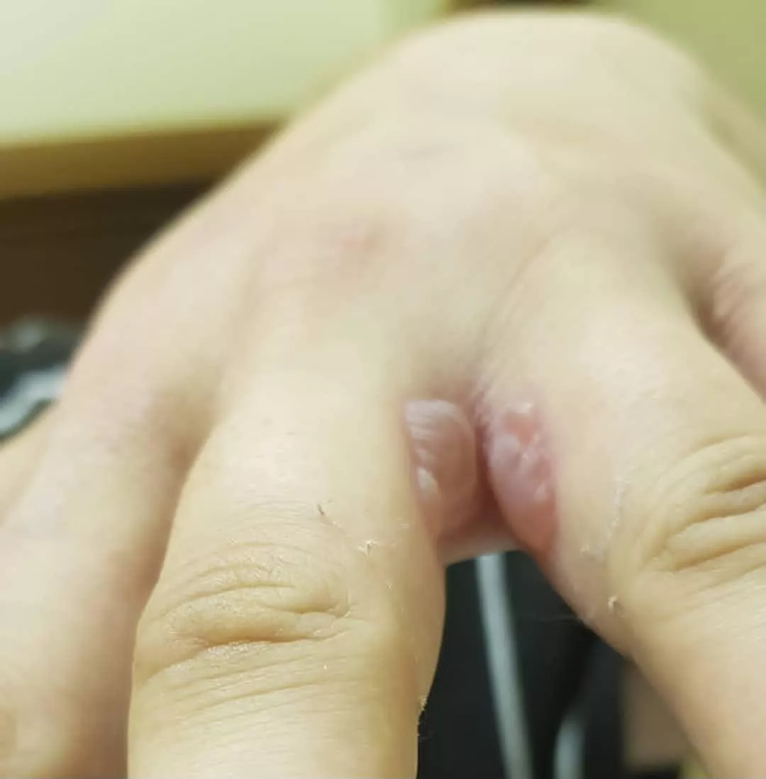 Forbidden blister pop, double the fun 🥴 posted by HoopDays