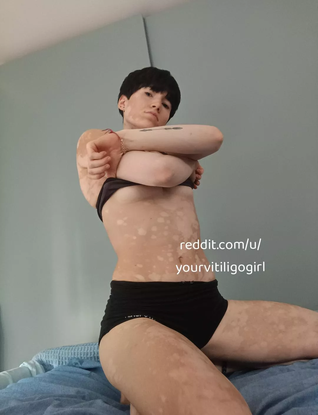 It's so hot today  posted by yourvitiligogirl