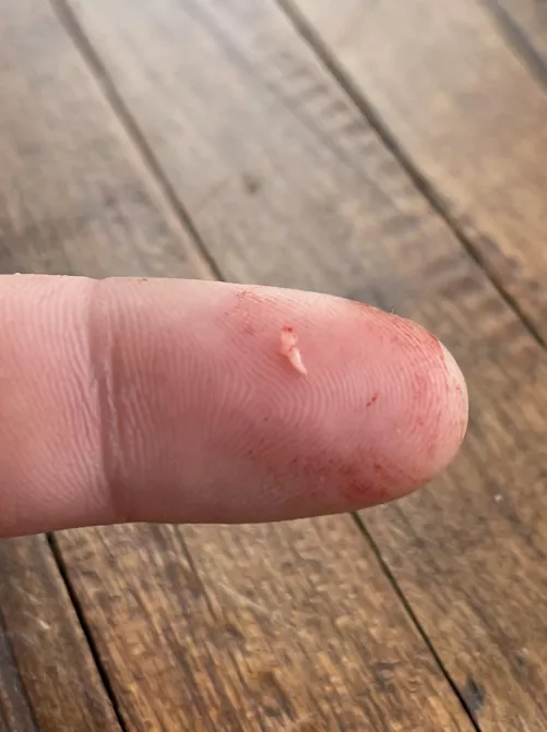 Angry Painful Butt Cheek Cyst by DopeZulla3000