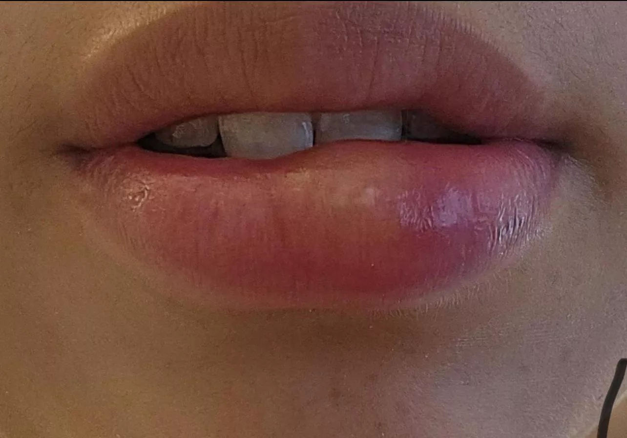 cold sore fetish? posted by iluvhellokitty999