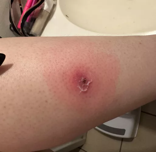 A fun lil update on my leg by krisc2619