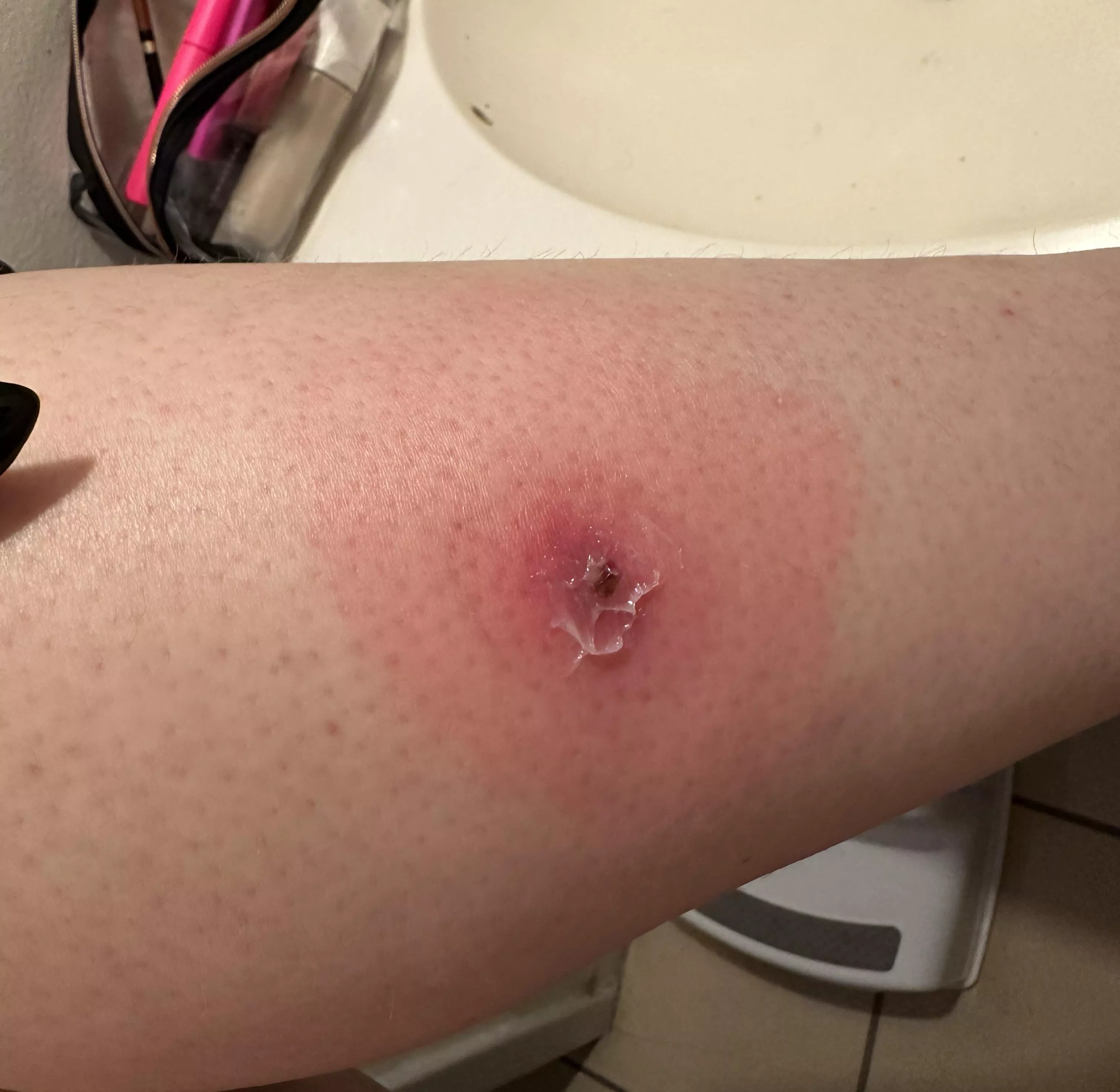 A fun lil update on my leg posted by krisc2619