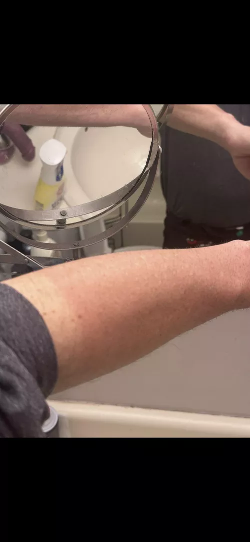 First Sunburn of 24 by Holiday-Influence815